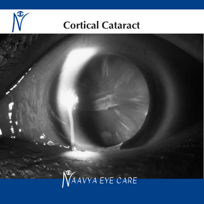 Cortical Cataracts